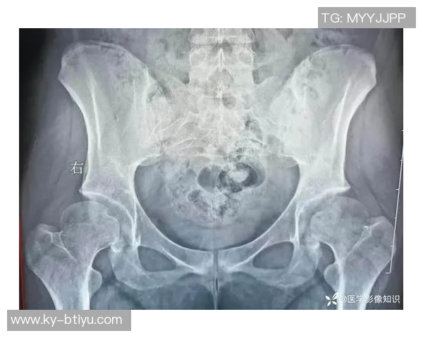 医生解析耻骨炎对亚马尔的影响及其过度使用损伤的成因与后果